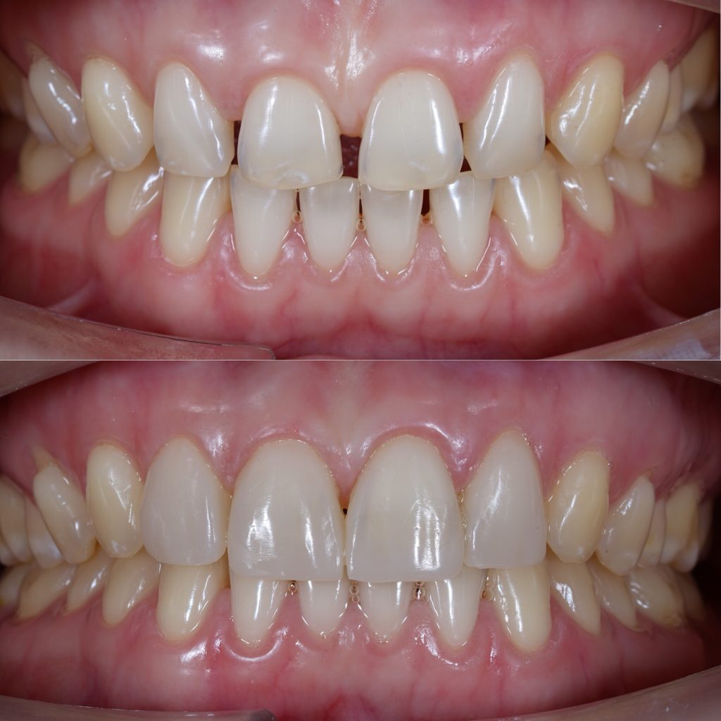 A before and after image of composite bonding on real teeth